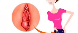Bartholin's gland abscess manifests itself as severe pain and swelling in the labia area