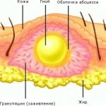 Абсцесс ягодицы