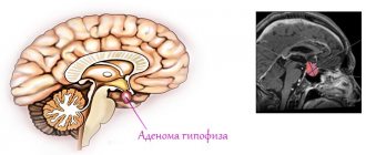 Аденома гипофиза