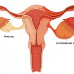 Аднексит симптомы
