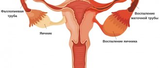Adnexitis symptoms