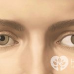 Ametropia can lead to strabismus and other complications