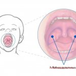 Sore throat in children