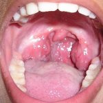 Ангина у взрослых часто лечится антибиотиками