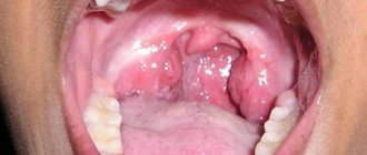 Sore throat in adults is often treated with antibiotics