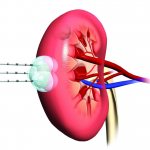 Ангиомиолипома почки