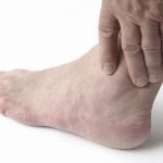 Arthritis of the ankle