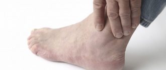 Arthritis of the ankle