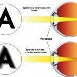 astigmatism of the eyes in adults