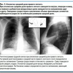 Atelectasis of the lung on a radiograph