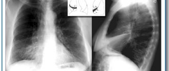 Atelectasis of the lung on a radiograph