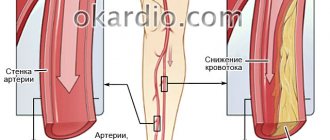 атеросклероз сосуда ноги