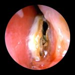 Atrophic rhinitis rhinoscopy