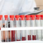 аутоантитела к торч инфекциям