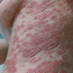 Аутоиммунные заболевания - симптомы и виды