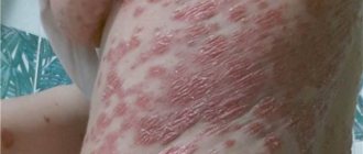 Autoimmune diseases - symptoms and types