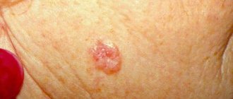 skin basalioma