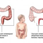 Hirschsprung&#39;s disease: norm and deviation