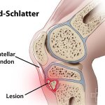 Schlatter&#39;s disease - destruction of the tibia