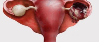 Painful uterus on palpation