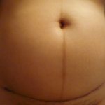 Болит живот после кесарева сечения