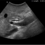 Abdominal pregnancy on ultrasound