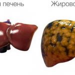 Чем опасен гепатоз при беременности