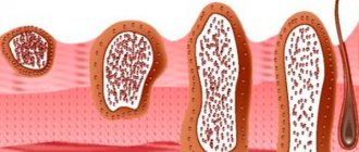 four stages of skin cancer