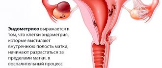 Что такое эндометриоз