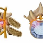 Что такое грыжа Шморля — причины, симптомы и методы лечения