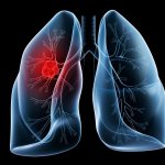 What is acute bronchitis