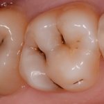 Cтадии кариеса