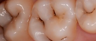 Cтадии кариеса