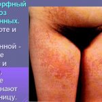 Дерматоз беременных