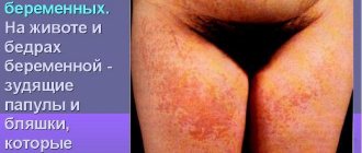 Dermatosis of pregnant women