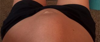diastasis rectus abdominis photo