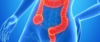 Дивертикулез толстого кишечника: симптомы, лечение и диета