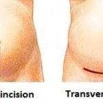 экстренное кесарево сечение