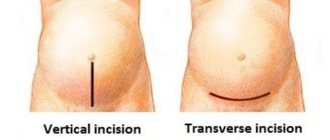 emergency caesarean section