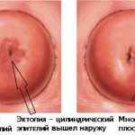 эктопия шейки матки