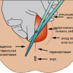 эпизиотомия фото