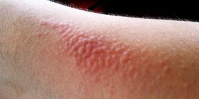 Если возникла аллергия, от использования гепариновой мази лучше отказаться