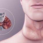 Эутиреоз щитовидной железы — что это такое, симптомы и лечение