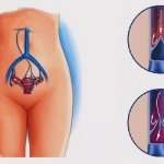 Формы и степени варикоза малого таза