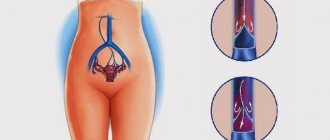 Forms and degrees of pelvic varicose veins