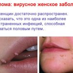 Photos of the viral female disease papilloma