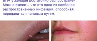 Фотографии вирусного женского заболевания папиллома