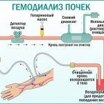 Гемодиализ: показания