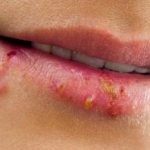 Герпес на губах