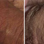 герпес у мужчин